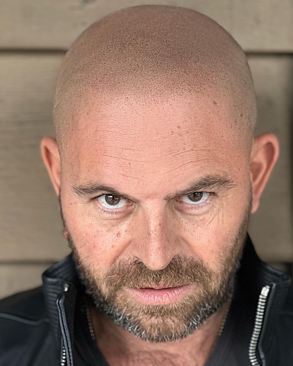Natural-looking scalp micropigmentation hairline on a fair-skinned client with a clean buzz-cut look