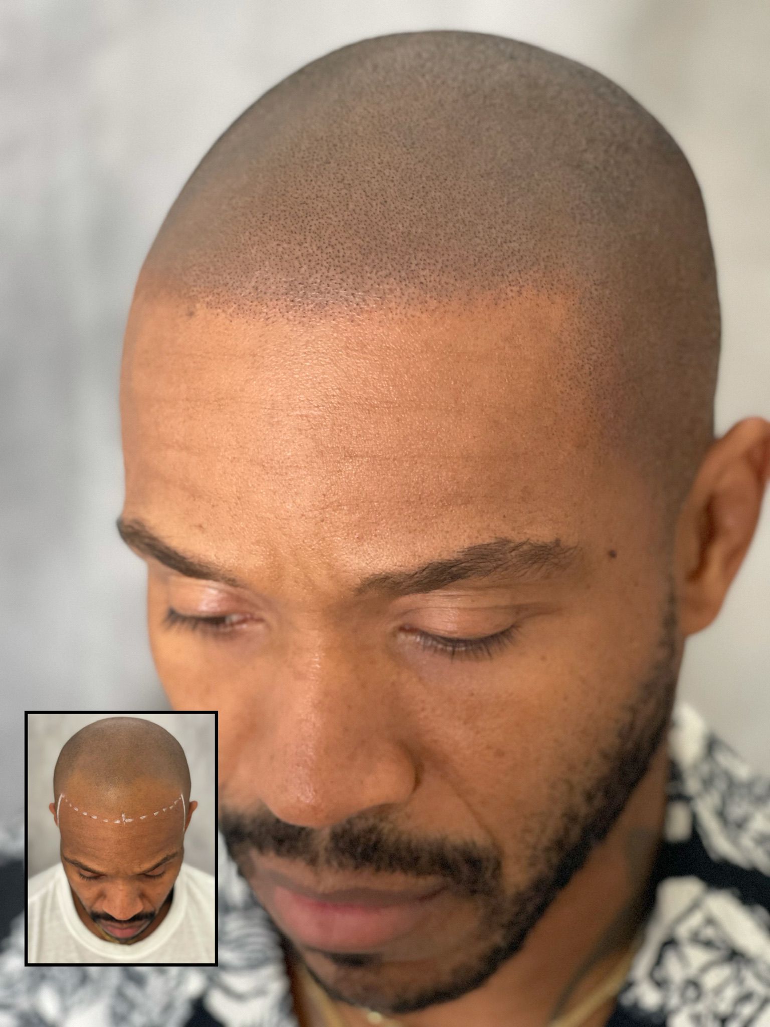 Scalp micropigmentation density and hairline restoration on a shaved head, with the before shot inset showing the mapped hairline
