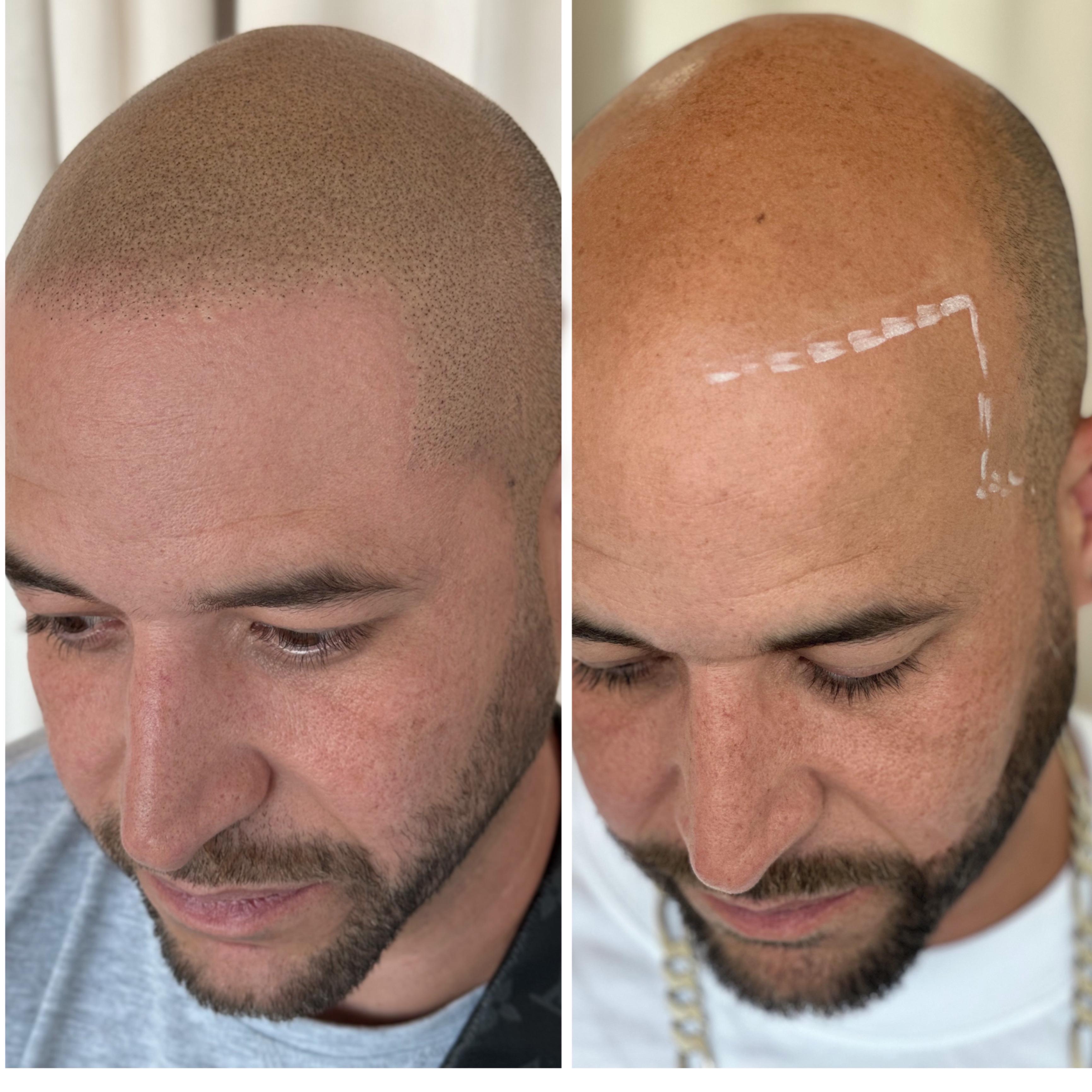 Scalp micropigmentation before and after — a bald hairline mapped in white pencil on the right, rebuilt with natural-looking density on the left