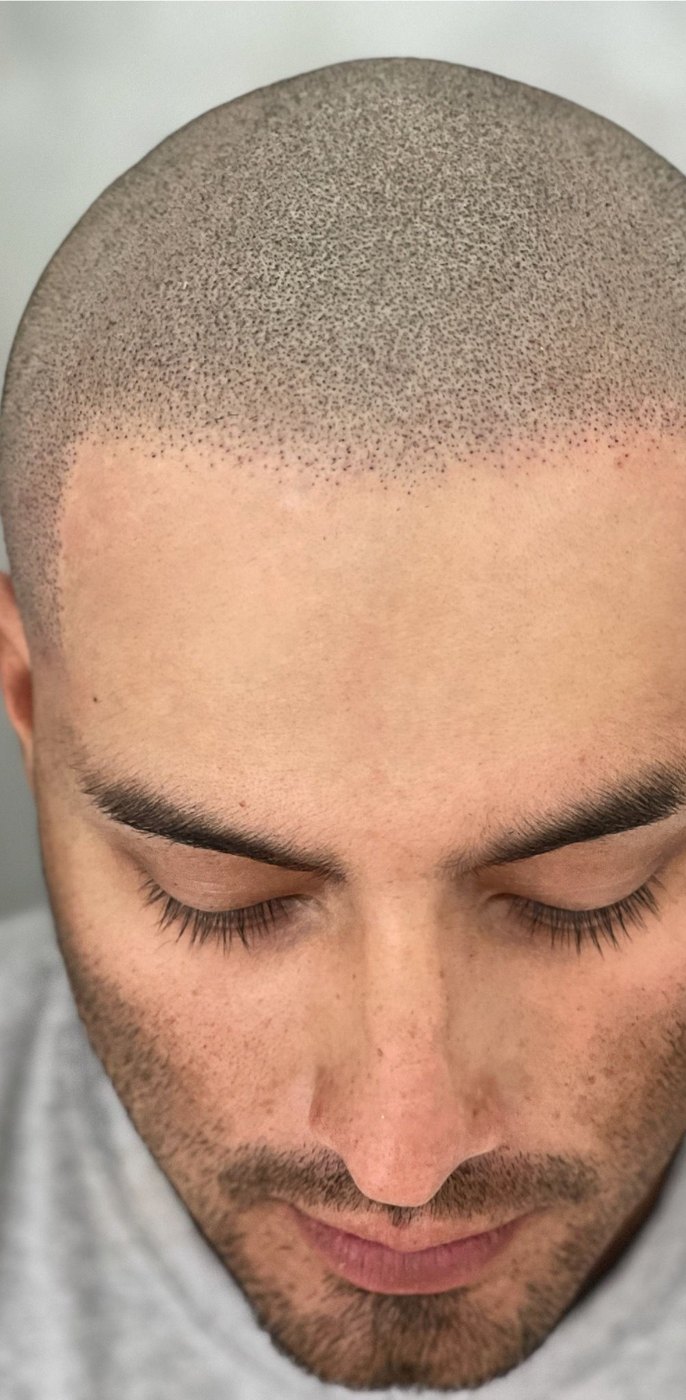 Hairline design scalp micropigmentation result by Picasso Jeff