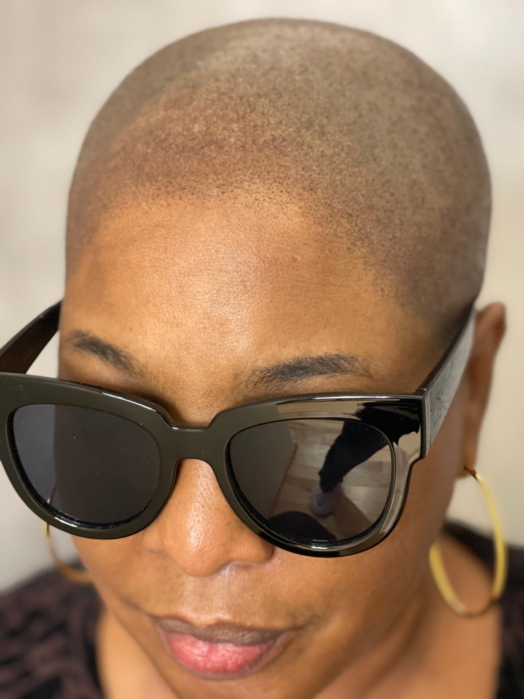 Women's scalp micropigmentation density result by Picasso Jeff